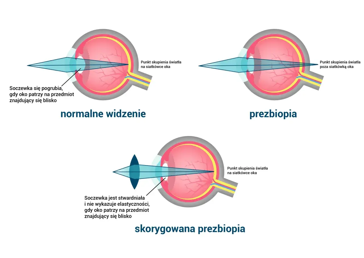 Ilustracja ukazuje funkcje oka: normalne widzenie, prezbiopię i skorygowaną prezbiopię, pokazując skupienie światła na siatk&oacute;wce lub poza nią.