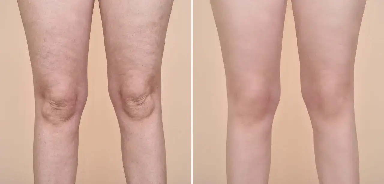 Przed i po endermologii: widoczne wygładzenie skóry, redukcja cellulitu i poprawa napięcia. Efekty zabiegu endermologii są imponujące.