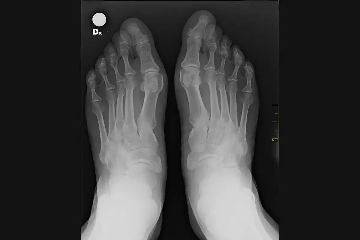 Radiografia dei piedi che mostra la deviazione dell'alluce verso le altre dita, indicativa di alluce valgo.