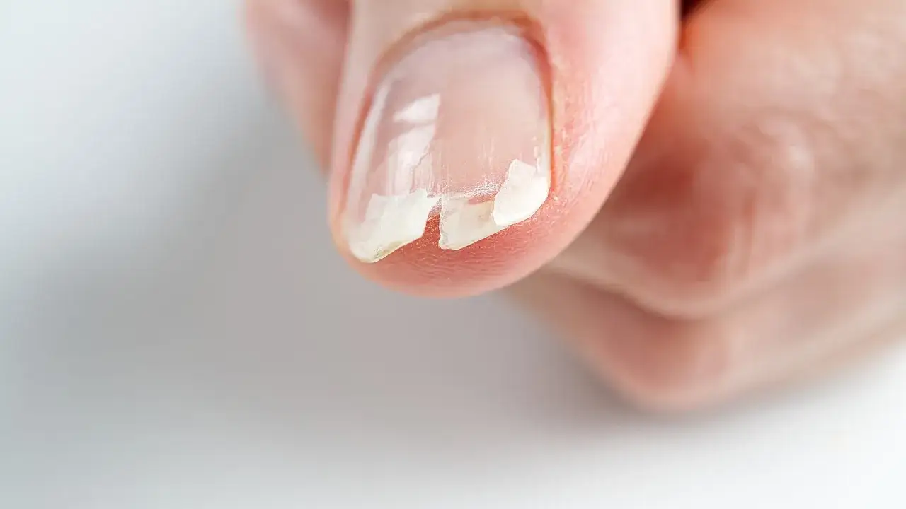 En närbild på ett finger med ett nagel som flagnar och ser svagt ut. Drömmen om starkare naglar känns långt borta.