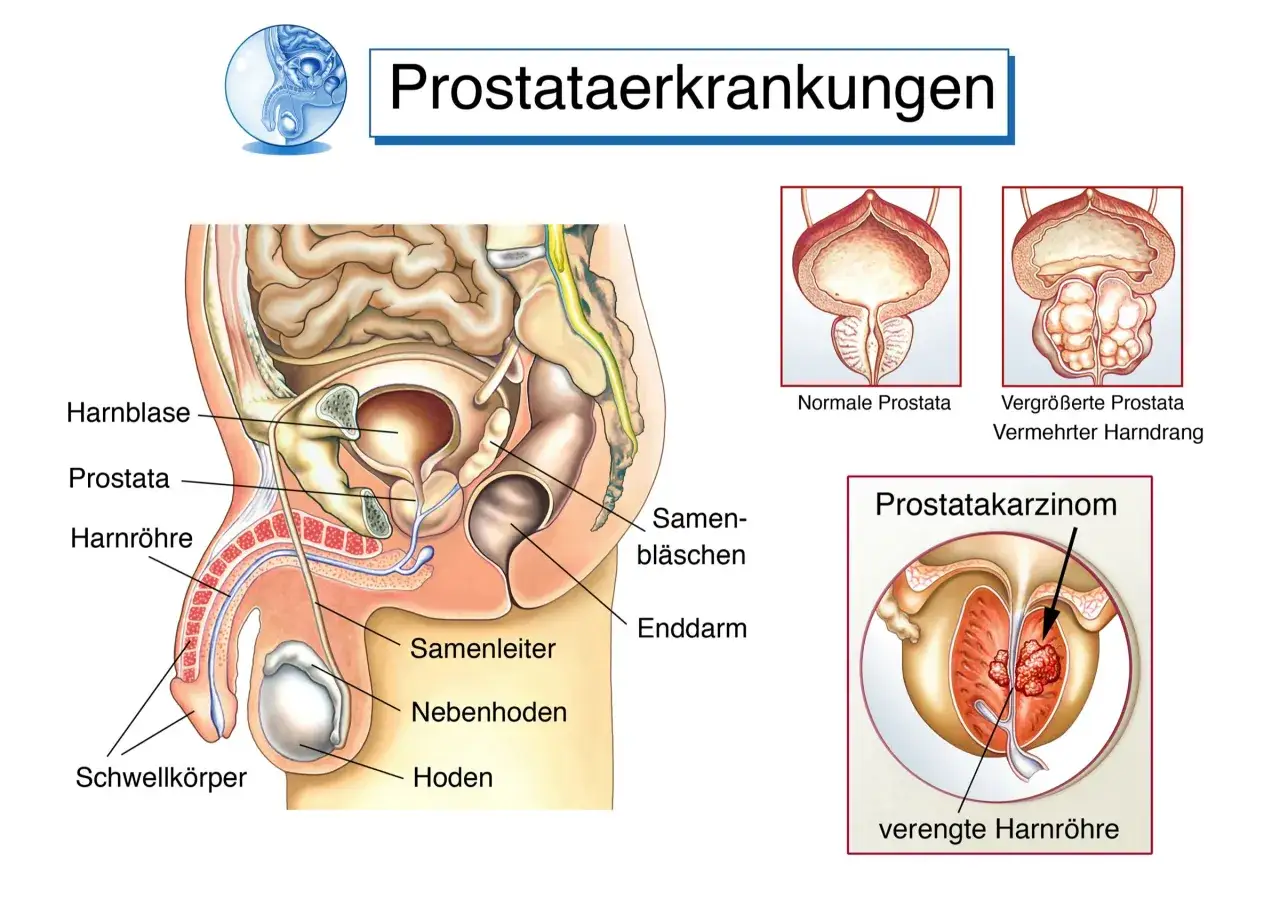 Anatomische Darstellung der Prostata und umliegender Organe. Zeigt normale, vergr&ouml;&szlig;erte Prostata und Prostatakarzinom, was auf m&ouml;gliche Prostata Symptome hinweist.