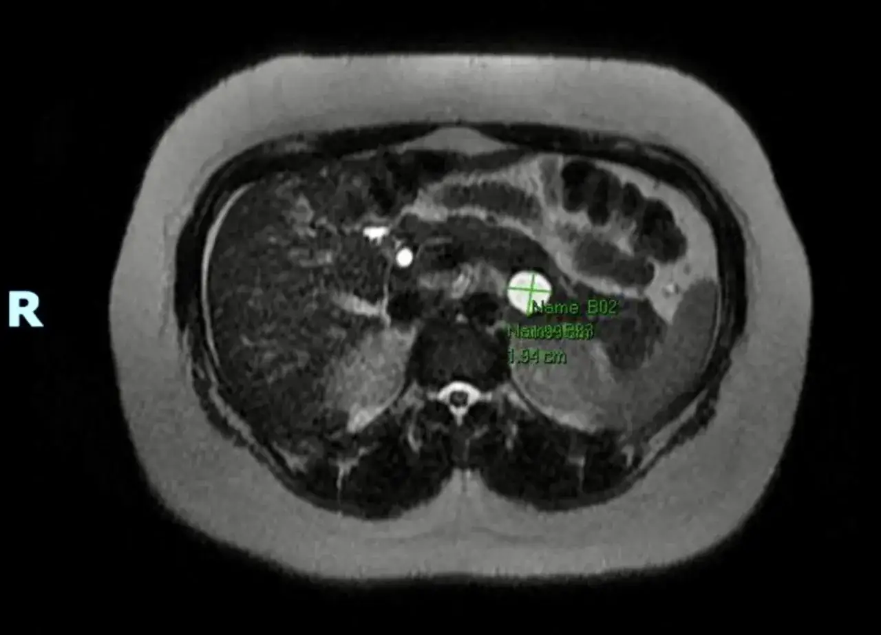 Przekrój MRI jamy brzusznej z widoczną torbielą na trzustce o wymiarach 1.94 cm.