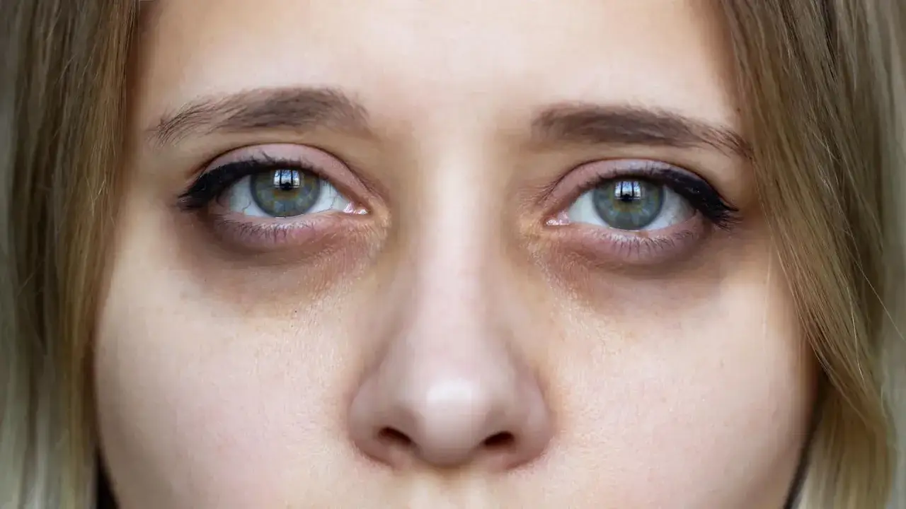 Augenringe mangel an Schlaf oder Stress. Dunkle Schatten unter den Augen.