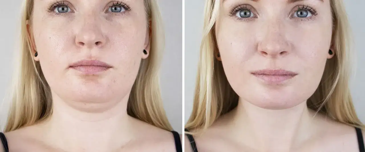 Före- och efterbilder visar en kvinna med synlig fettfrysning dubbelhaka som minskat markant.