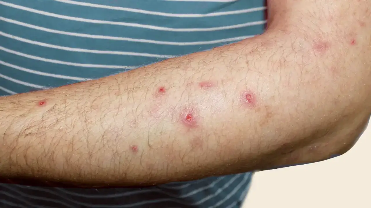 Ręka z licznymi, czerwonymi zmianami skórnymi, które mogą być objawem świerzbiączki guzkowej. Szukamy domowych sposobów na ulgę.