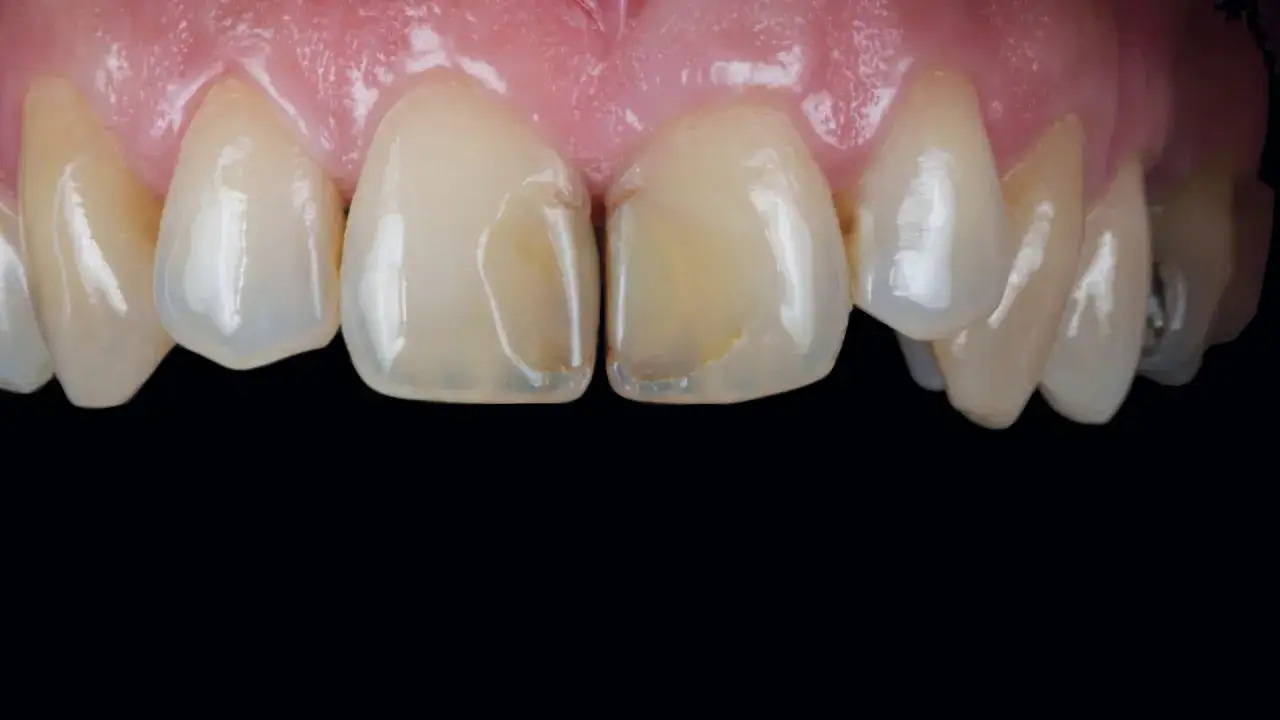Denti rifatti con corone in ceramica, mostrando un sorriso luminoso e naturale.