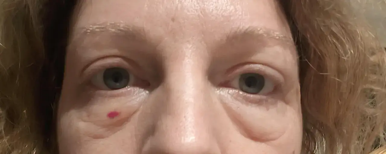 Oko z zaczerwienieniem pod skórą, widoczne oznaki obrzęku i zmarszczki. Możliwe skinbooster powikłania.