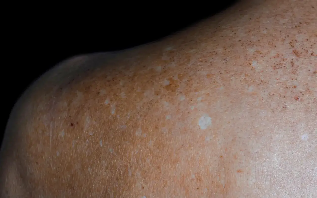 Gros plan sur une épaule montrant des taches de dépigmentation de la peau, des zones plus claires contrastant avec la peau bronzée et des taches de rousseur.