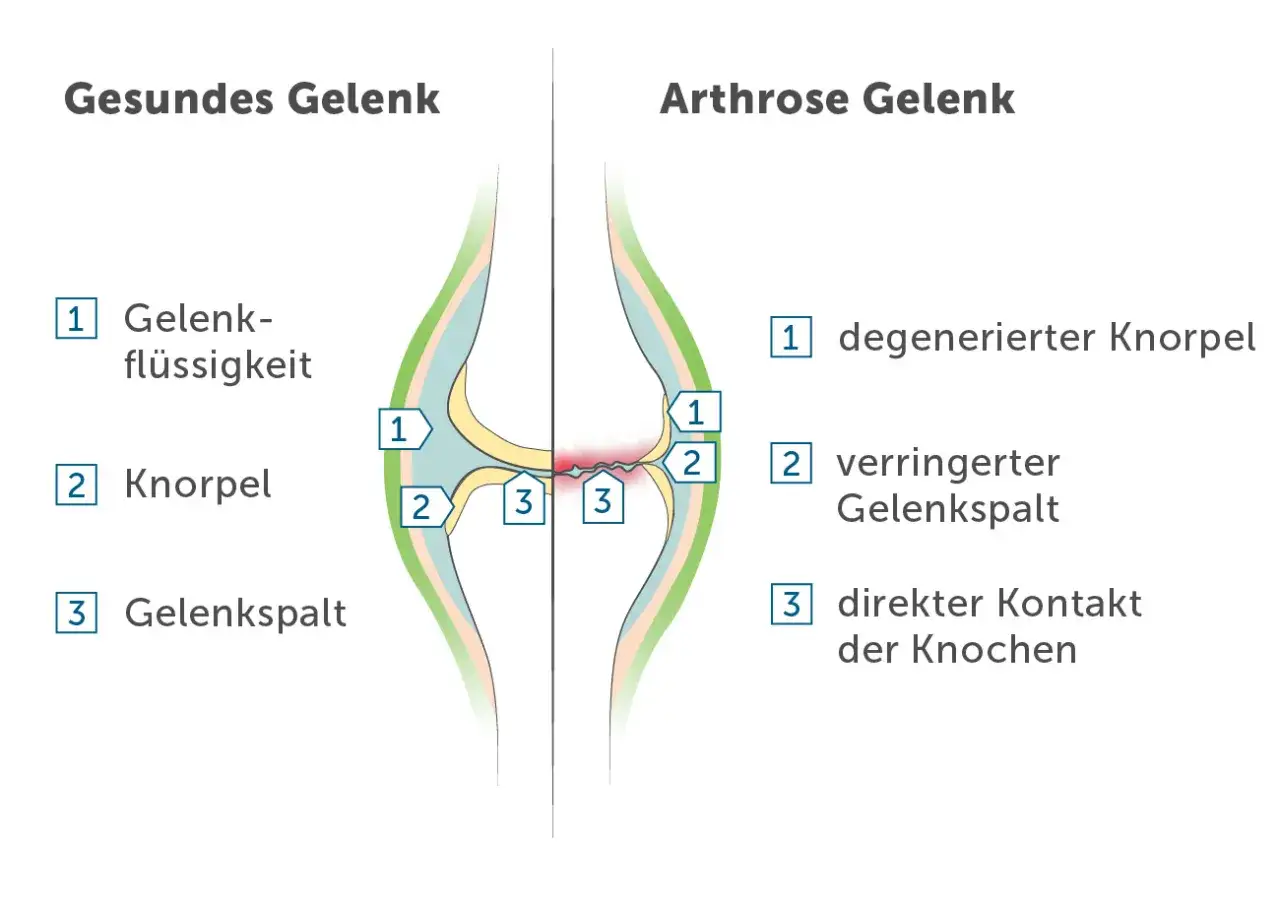 Vergleich eines gesunden Gelenks mit einem Arthrose-Gelenk. Bei Arthrose im Knie ist der Knorpel degeneriert, der Gelenkspalt verringert und es kommt zum direkten Kontakt der Knochen.