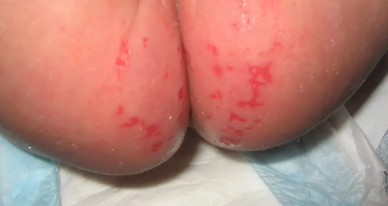 Bebé con erupción roja y escamosa en la zona del pañal, indicativa de candidiasis del pañal.