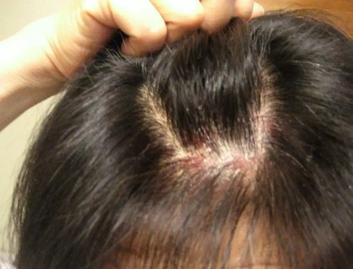 Una persona se rasca la cabeza, mostrando irritación y pérdida de cabello. Me pica la cabeza y se me cae el pelo.