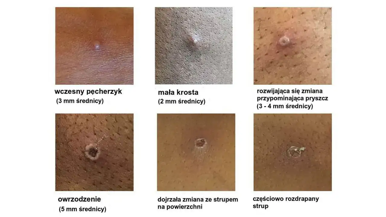 rozdrapany pryszcz pierwsza pomoc