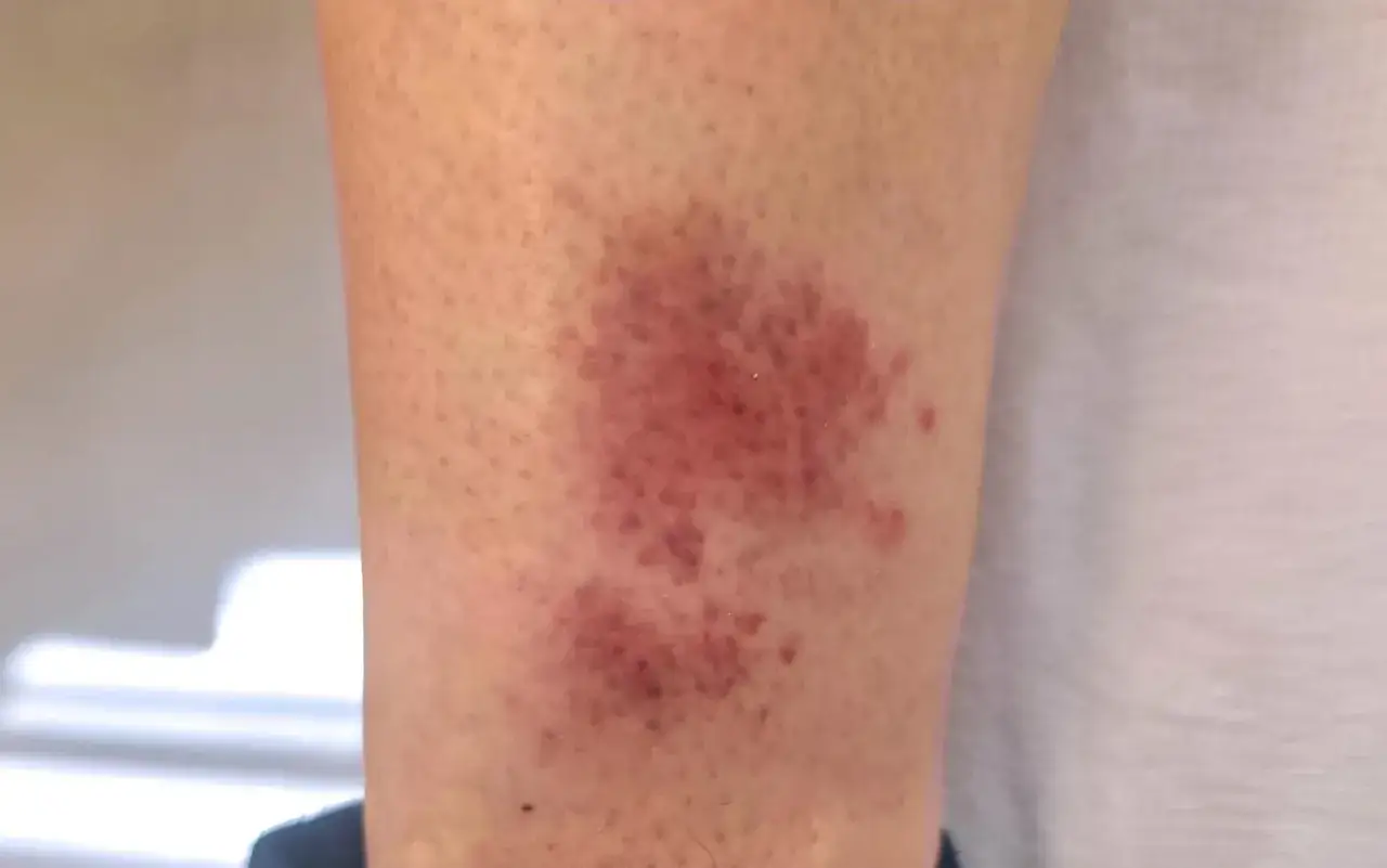 Gros plan d'une **plaque rouge sur les jambes**, semblant être une éruption cutanée ou une ecchymose.
