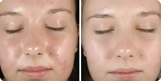 mezoterapia igłowa twarzy, peeling chemiczny zabieg, oxybrazja przed i po