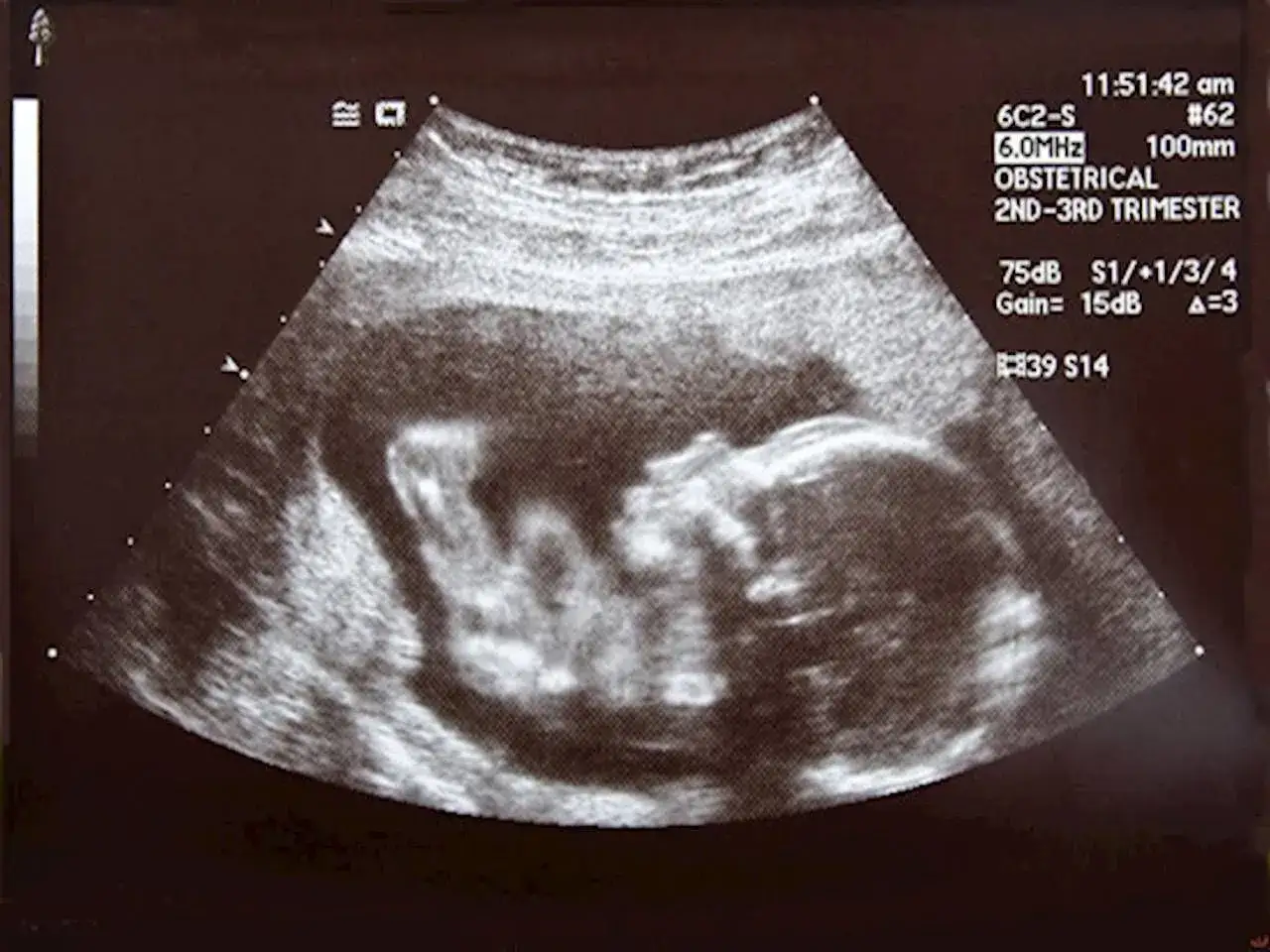 USG płodu, widoczna główka i tułów. Badanie USG jest kluczowe w diagnostyce wielowodzia i wad płodu.