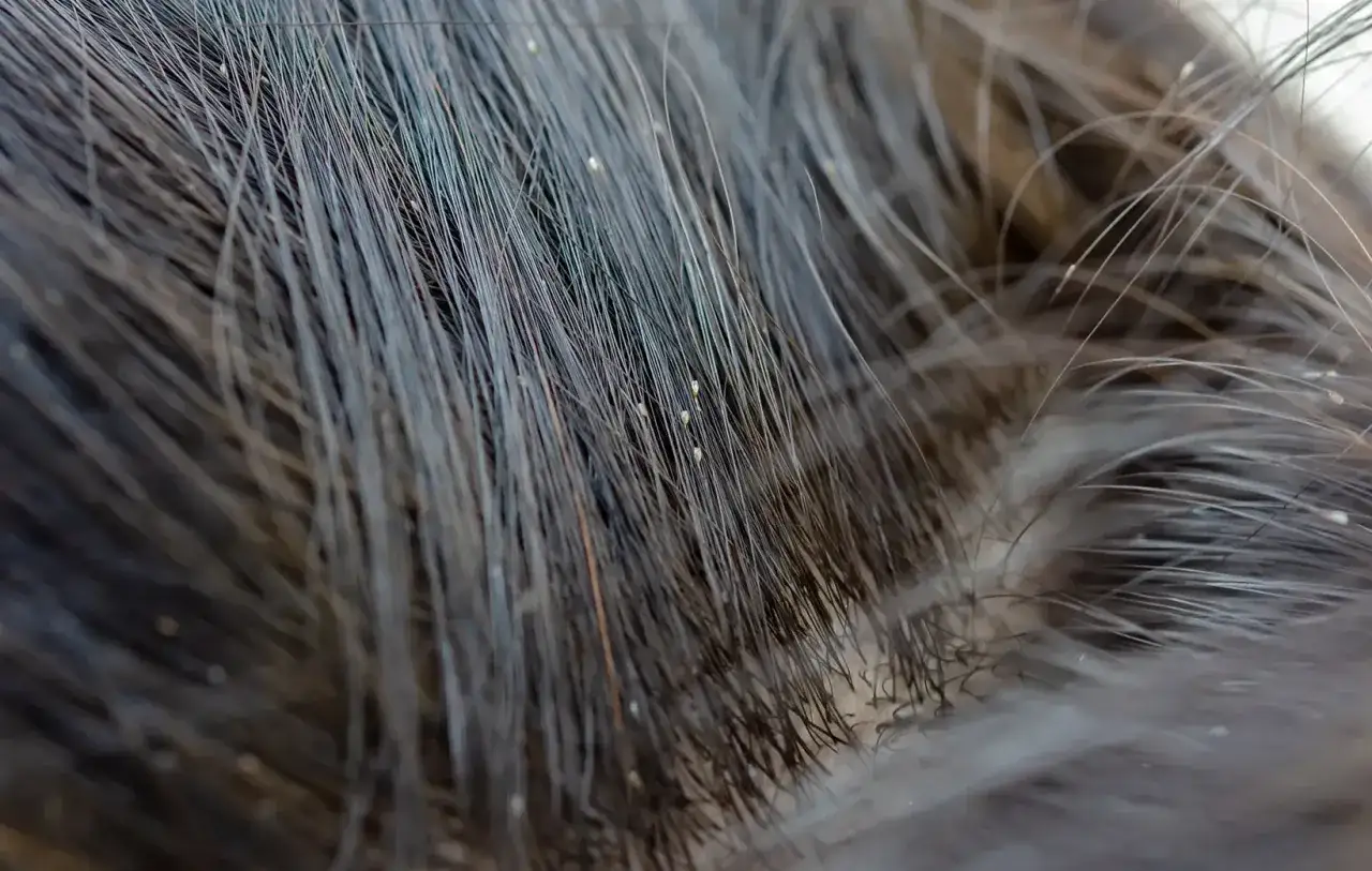 Piccolo gruppo di uova di pidocchi morte attaccate ai capelli scuri.