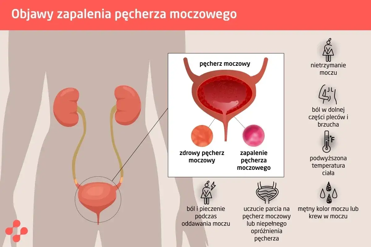 Ból i pieczenie podczas oddawania moczu to jeden z objawów zapalenia pęcherza. Grafika pokazuje układ moczowy i objawy infekcji.