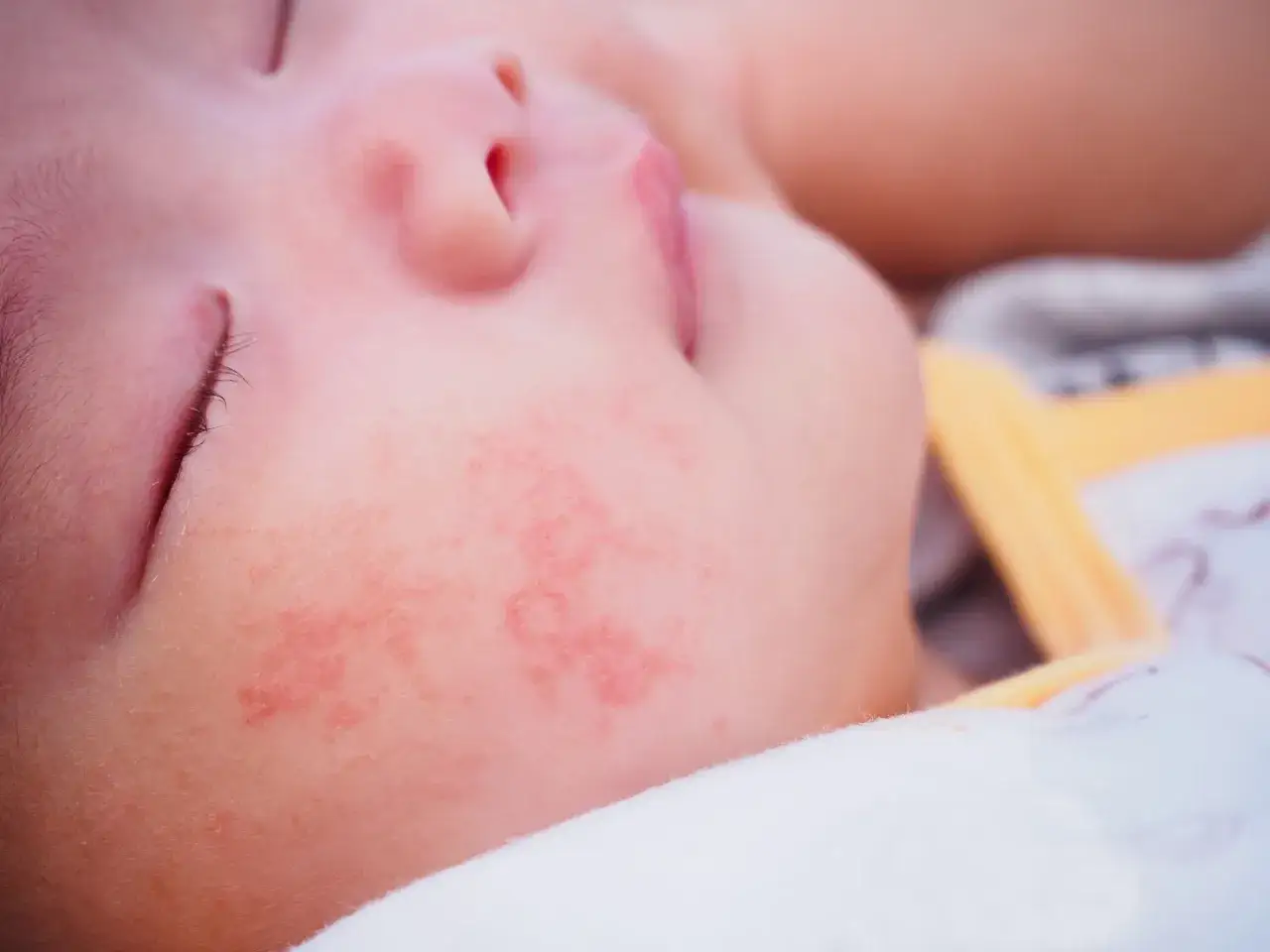 Primo piano del viso di un neonato con chiazze rosse, indicative di orticaria neonato.