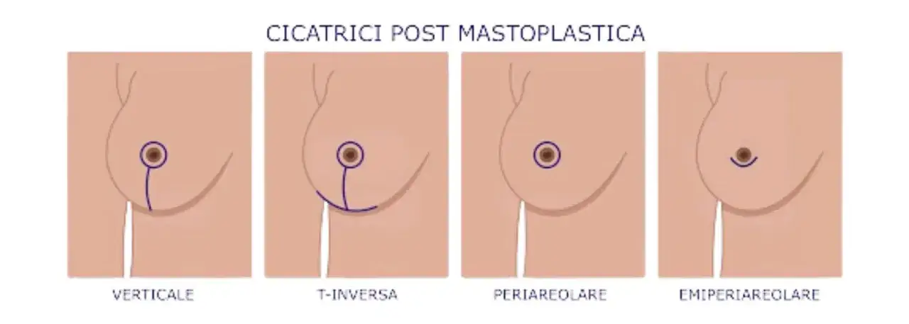 Illustrazione delle cicatrici post mastoplastica: verticale, T-inversa, periareolare ed emi-periareolare. Diverse opzioni per un seno rifatto.