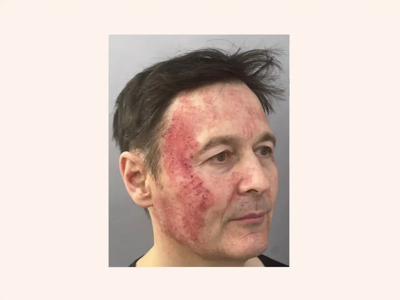 Mann mit ger&ouml;teter Haut direkt nach Laserbehandlung im Gesicht, besonders an Stirn und Wange.