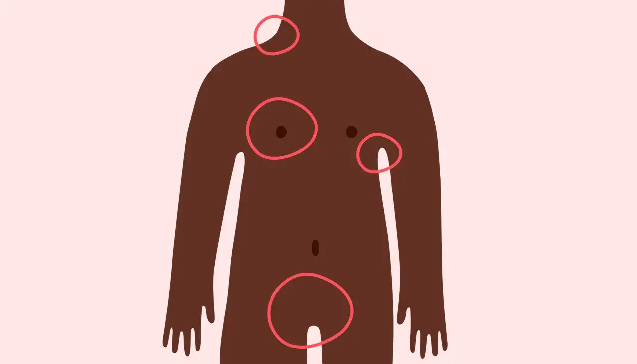 Illustration d'un torse humain avec des cercles rouges indiquant des zones d'intérêt, possiblement un bouton dur sous la peau.