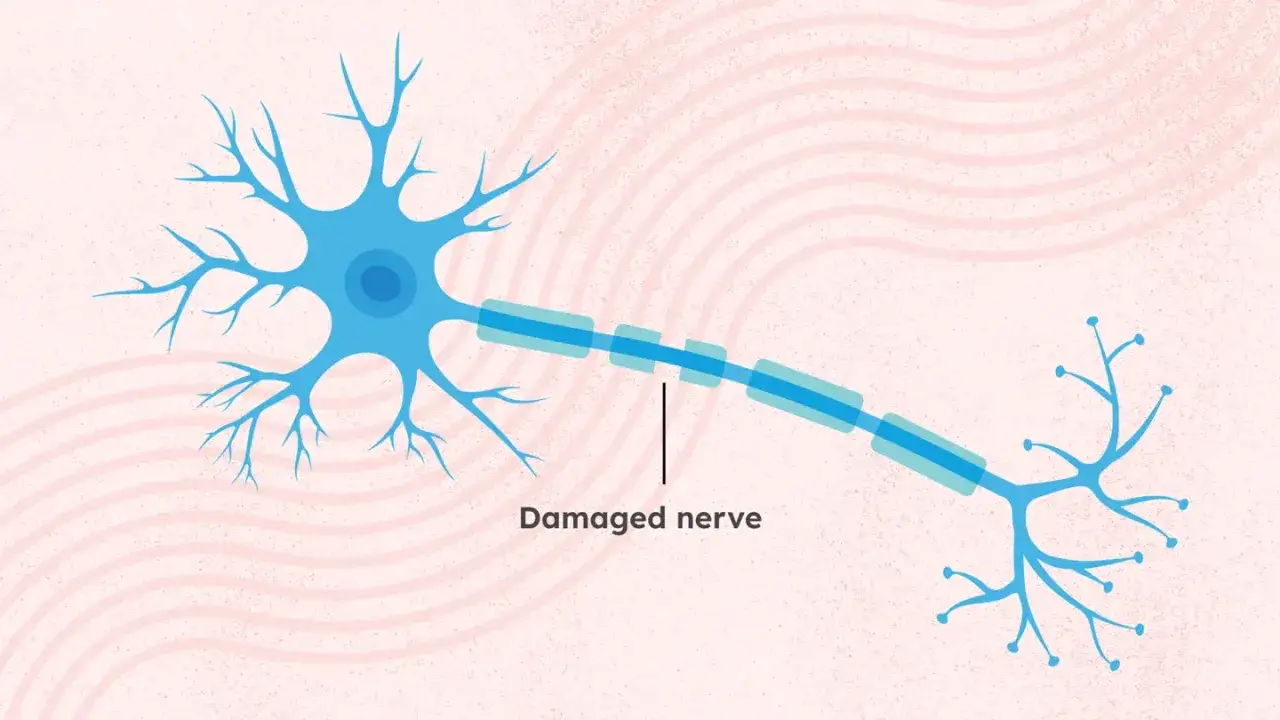 Illustrazione di un neurone con assone danneggiato, che rappresenta la CIDP malattia.
