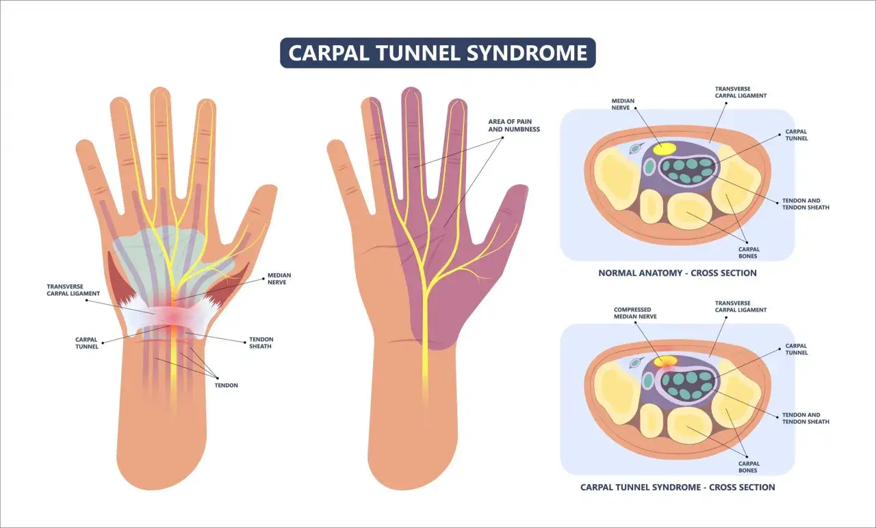 Illustrazione anatomica del polso che mostra la compressione dei nervi del polso nella sindrome del tunnel carpale.