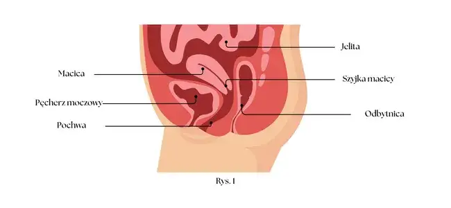 endometrioza głęboko naciekająca schemat