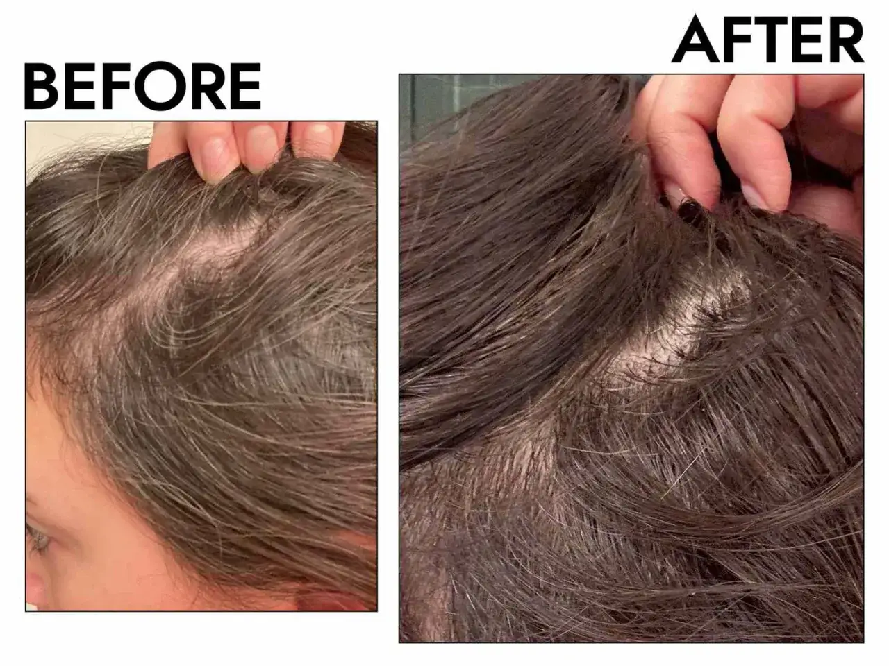 Antes y después de un tratamiento para la caída del cabello en mujeres. Se observa una mejora notable en la densidad capilar.