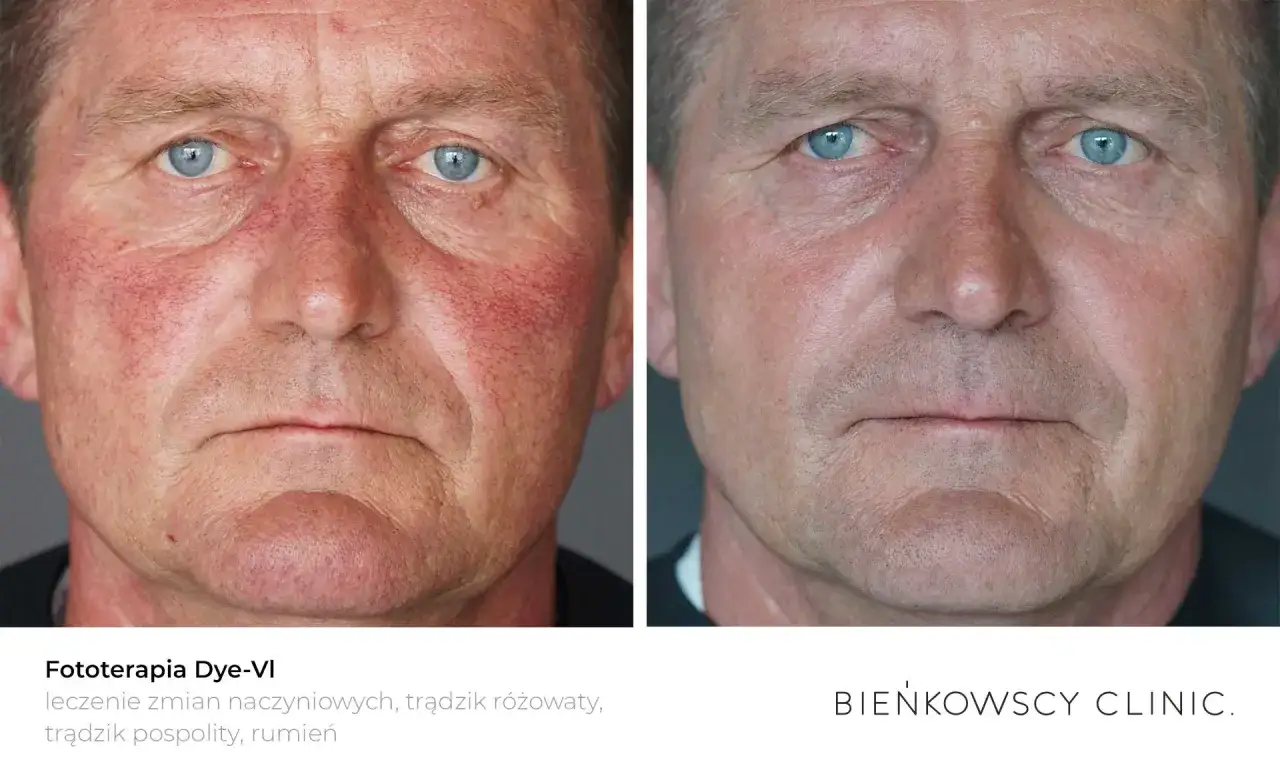 Przed i po zabiegu fototerapii Dye-VI. Widoczna redukcja rumienia różowatego i zmian naczyniowych na twarzy mężczyzny.