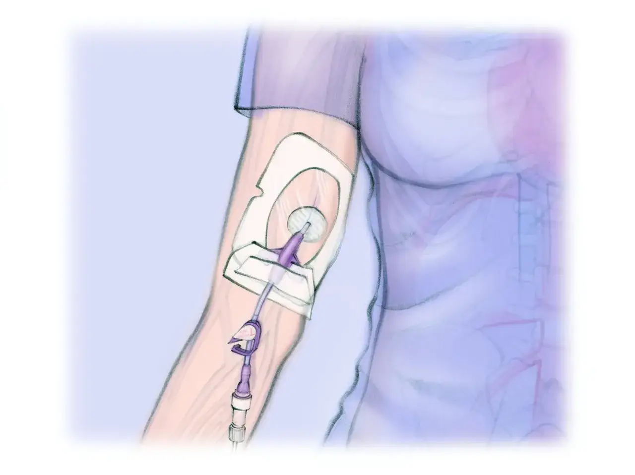 Illustrazione del processo di inserimento PICC. Un catetere PICC &egrave; fissato al braccio con un cerotto, pronto per l'uso.