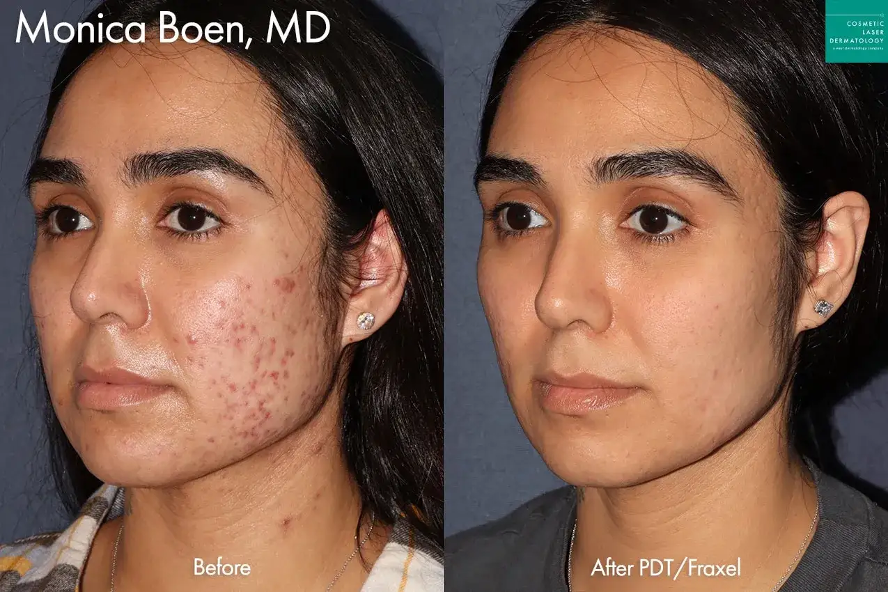 Comparación de rostro antes y después de tratamiento para marcas de acné. La imagen izquierda muestra piel con inflamación y marcas de acné. La imagen derecha muestra piel más lisa y uniforme.