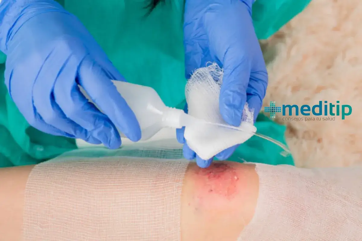 Manos enguantadas aplican soluci&oacute;n de clorhexidina a una gasa para limpiar heridas.
