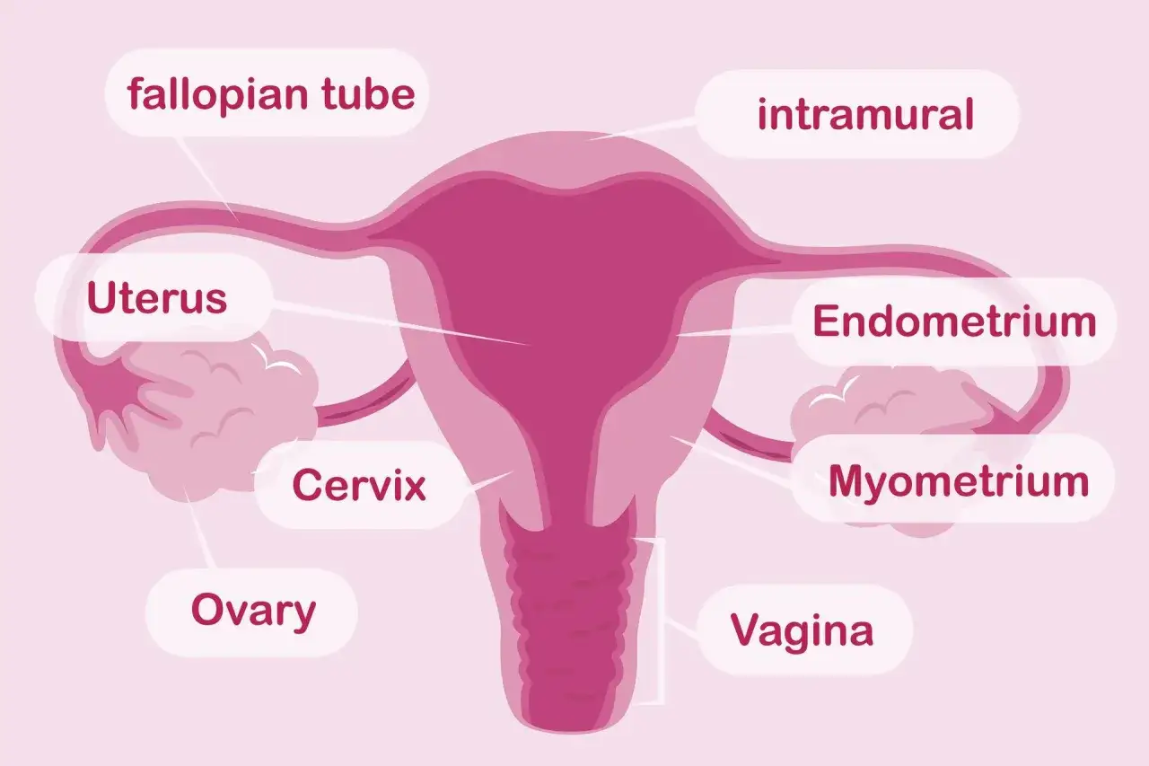 Schemat żeńskiego układu rozrodczego z zaznaczonymi narządami: macica, jajnik, jajowód, szyjka macicy, pochwa. W obrębie macicy widoczne endometrium i mięśniówka (myometrium), a także obszar intramuralny, gdzie może rozwijać się adenomioza.