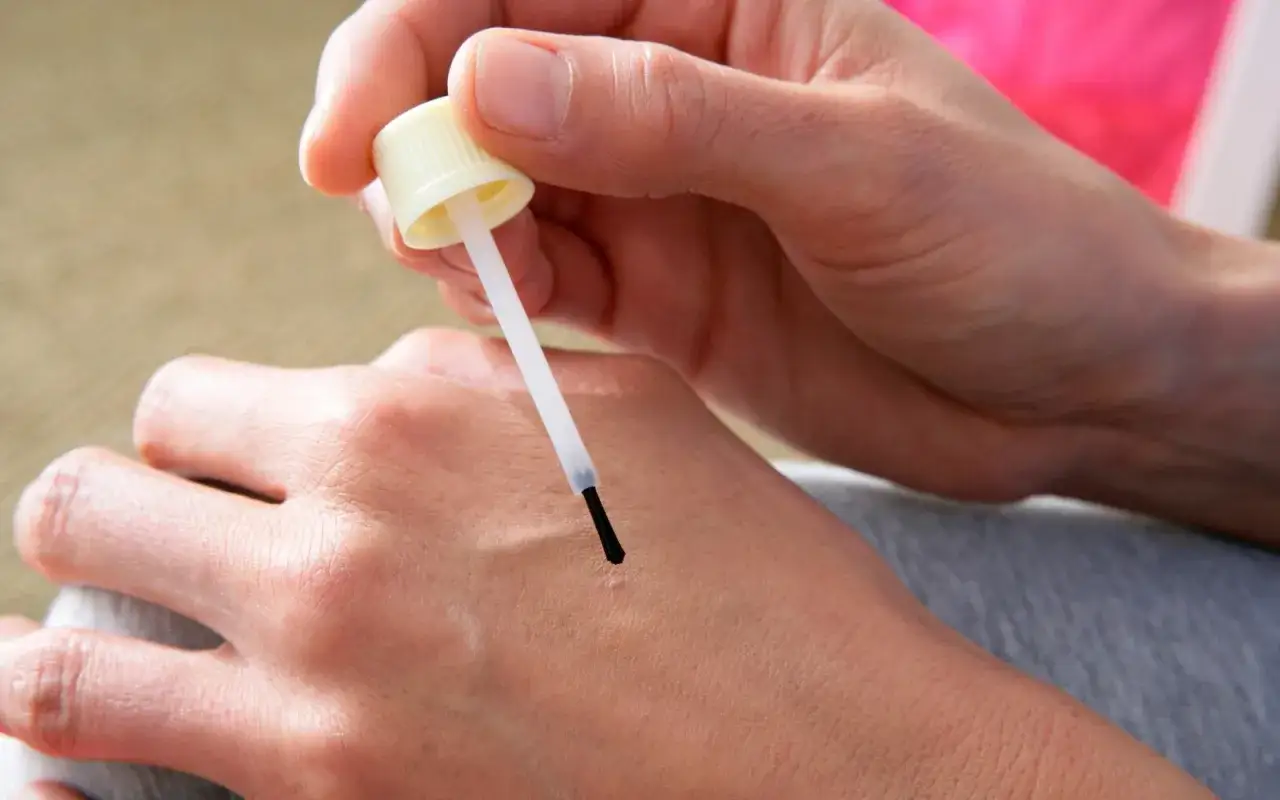Application d'acide salicylique sur une verrue pour le traitement.