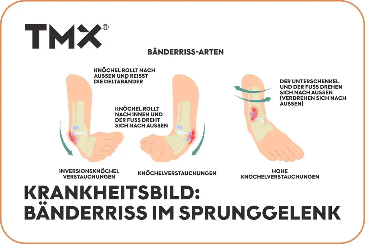 Illustrationen zeigen, wie ein **Sprunggelenk verstaucht** werden kann: Knöchel rollt nach außen oder innen, Fuß verdreht sich.