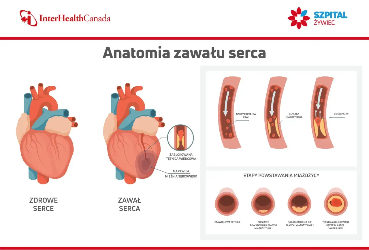 Anatomia zawału serca: zdrowe serce vs. zawał, zablokowana tętnica wieńcowa, martwica mięśnia sercowego. Etapy miażdżycy, wpływ na przepływ krwi. Podwyższona troponina może wskazywać na zawał.