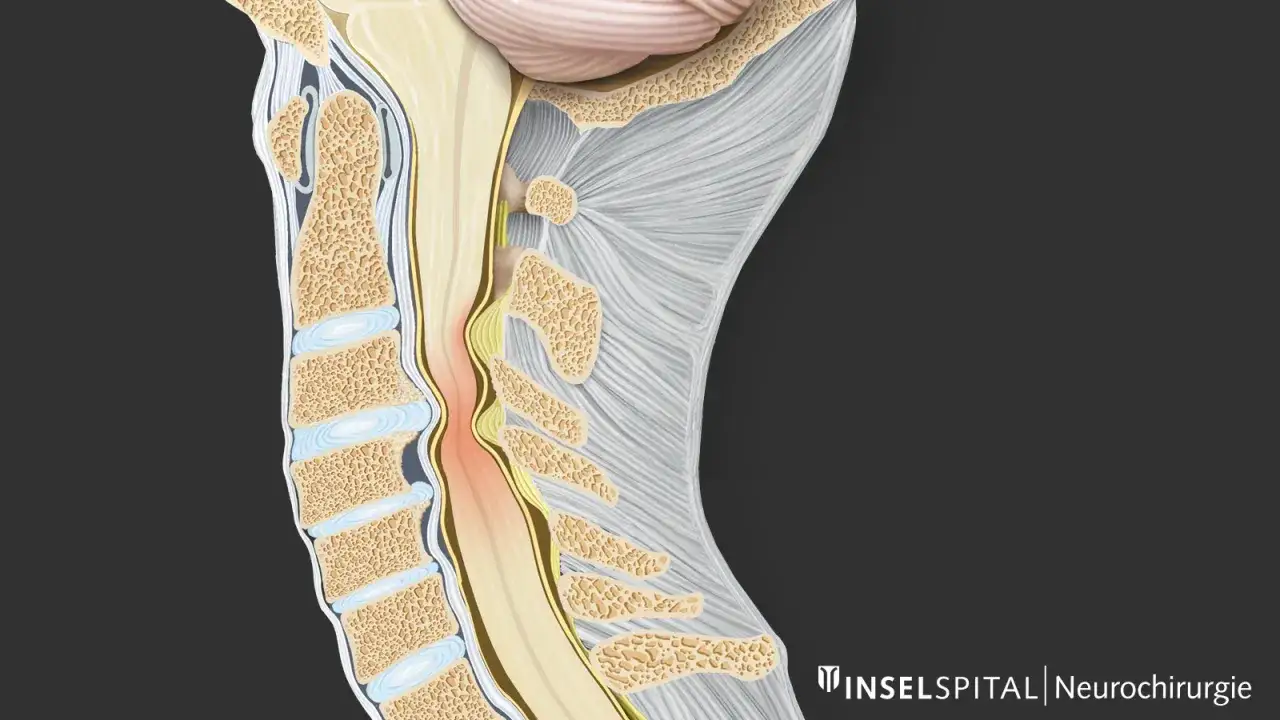 Darstellung einer Spinalkanalstenose im Halsbereich. Die Verengung des Kanals kann zu verschiedenen spinalkanalstenose symptome führen, wie Schmerzen oder Taubheitsgefühle.