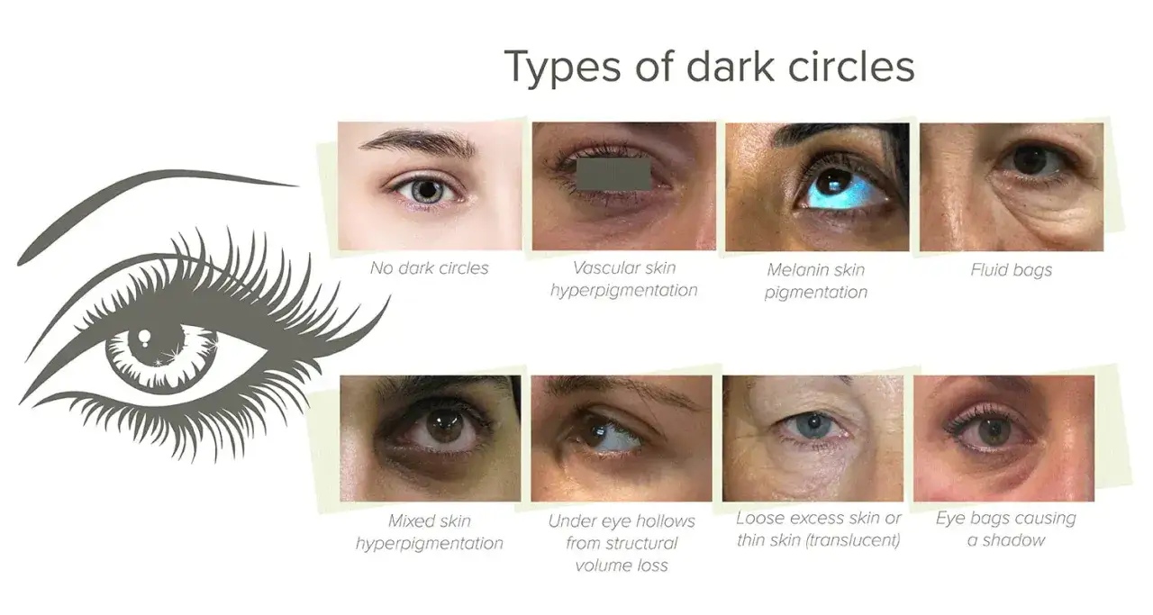 Comparaison des types de cernes : peau vasculaire, mélanine, poches, creux, peau fine. Parfois, j'ai des cernes noires sous les yeux.