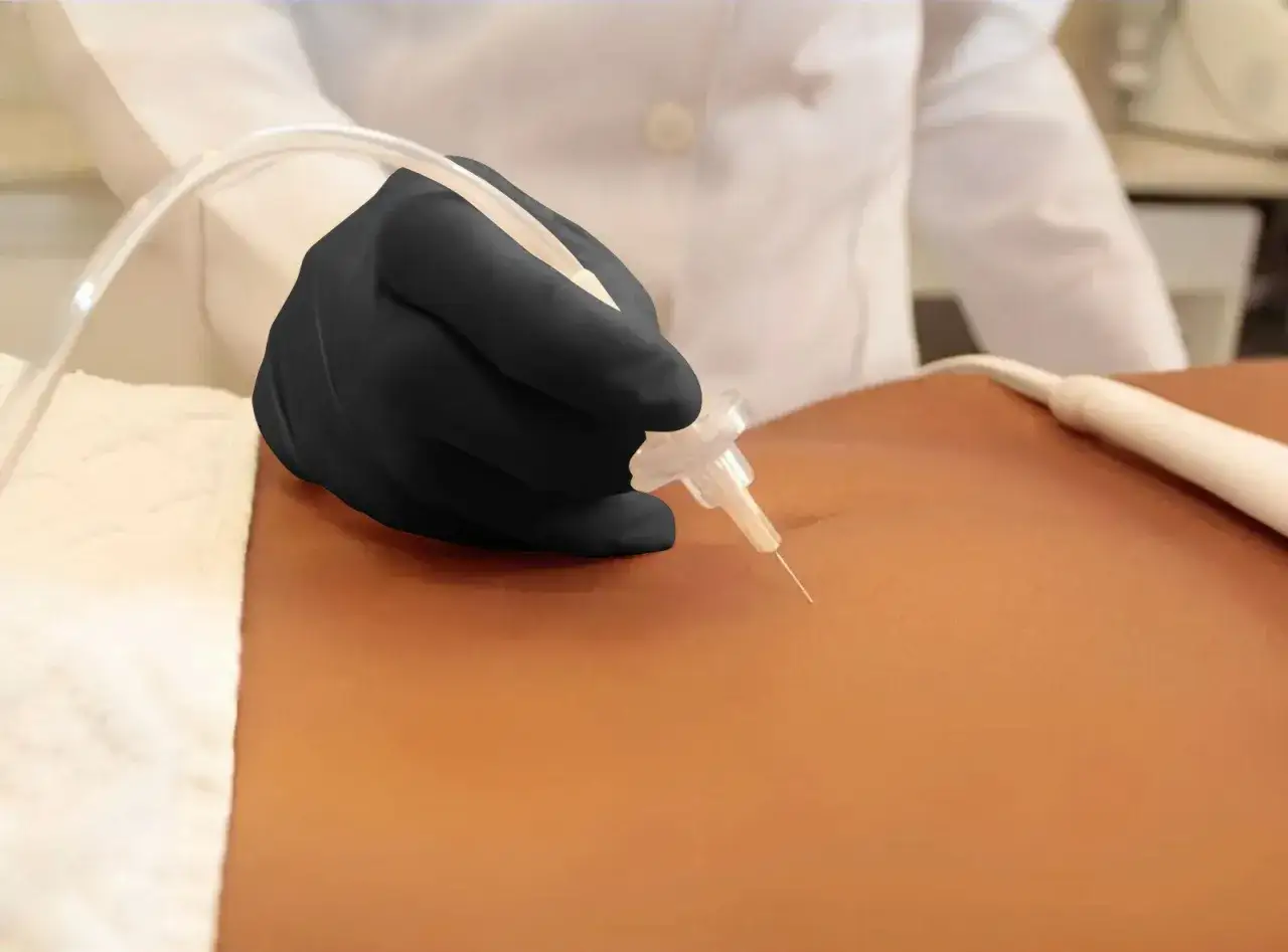 Manos enguantadas realizan carboxiterapia corporal, inyectando di&oacute;xido de carbono para mejorar la piel.