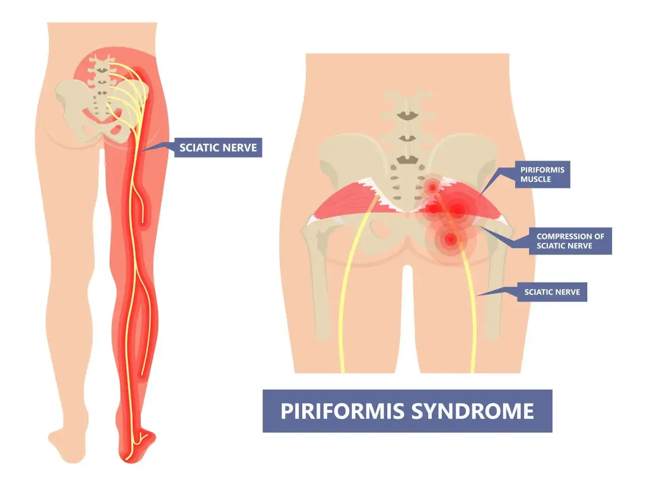 Illustration visar piriformis syndrom där piriformismuskeln trycker på ischiasnerven, vilket orsakar smärta längs benet.