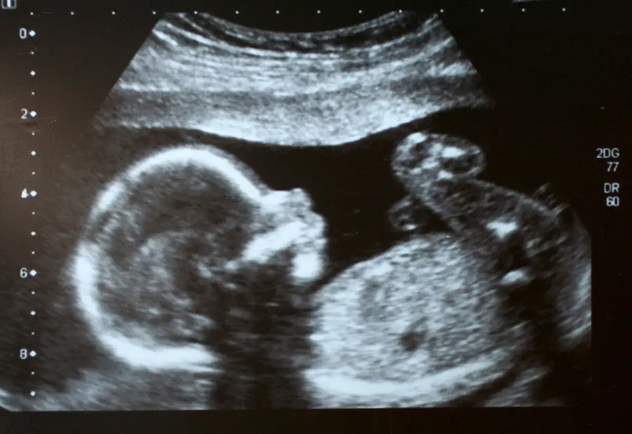 Ultraschallbild eines Babys in der 20. SSW. Der Kopf und der K&ouml;rper sind deutlich erkennbar, das Baby entwickelt sich gut.