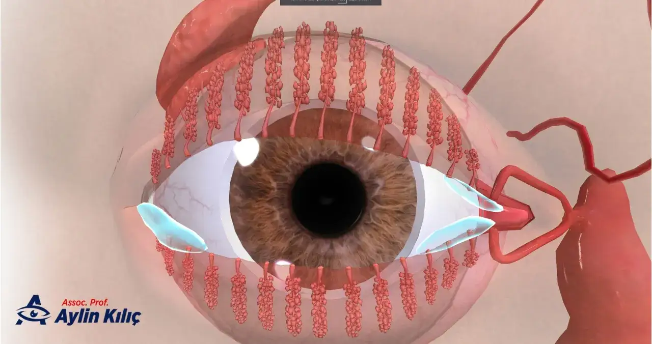 Dettaglio anatomico dell'occhio che illustra le ghiandole di Meibomio ostruite, potenziali cause di secchezza oculare.