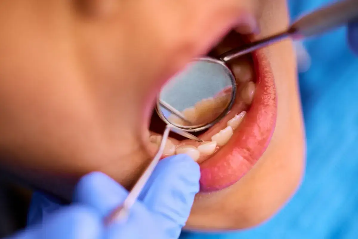 Dentysta zakłada plomba tymczasowa. Widać usta, zęby i narzędzia stomatologiczne.