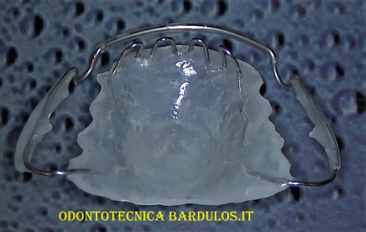 Un **elevatore linguale notturno** personalizzato, con filo metallico e base in resina trasparente, pronto per correggere la posizione dei denti durante il sonno.