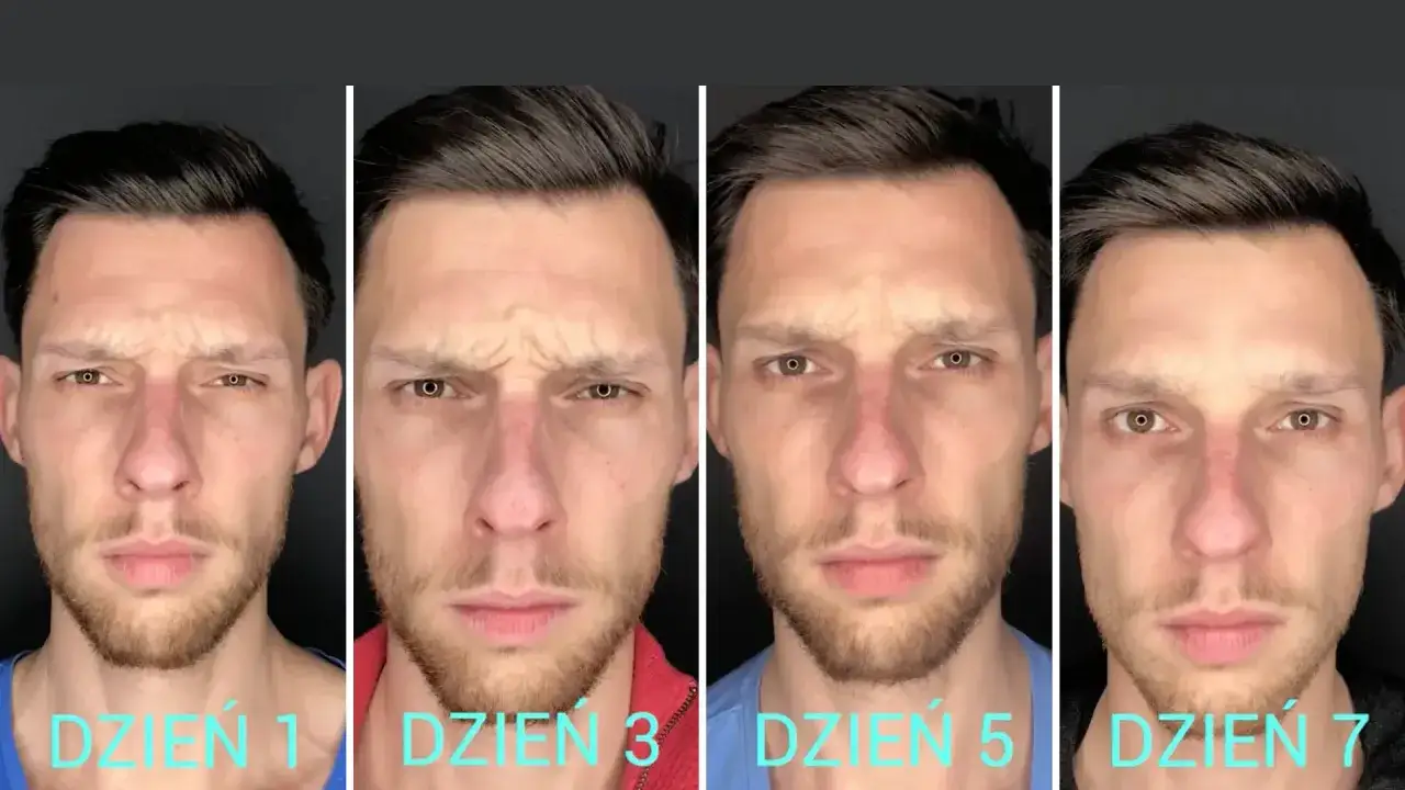 Mezobotox przed i po: mężczyzna z widocznymi zmarszczkami na czole, które stopniowo wygładzają się w ciągu 7 dni.