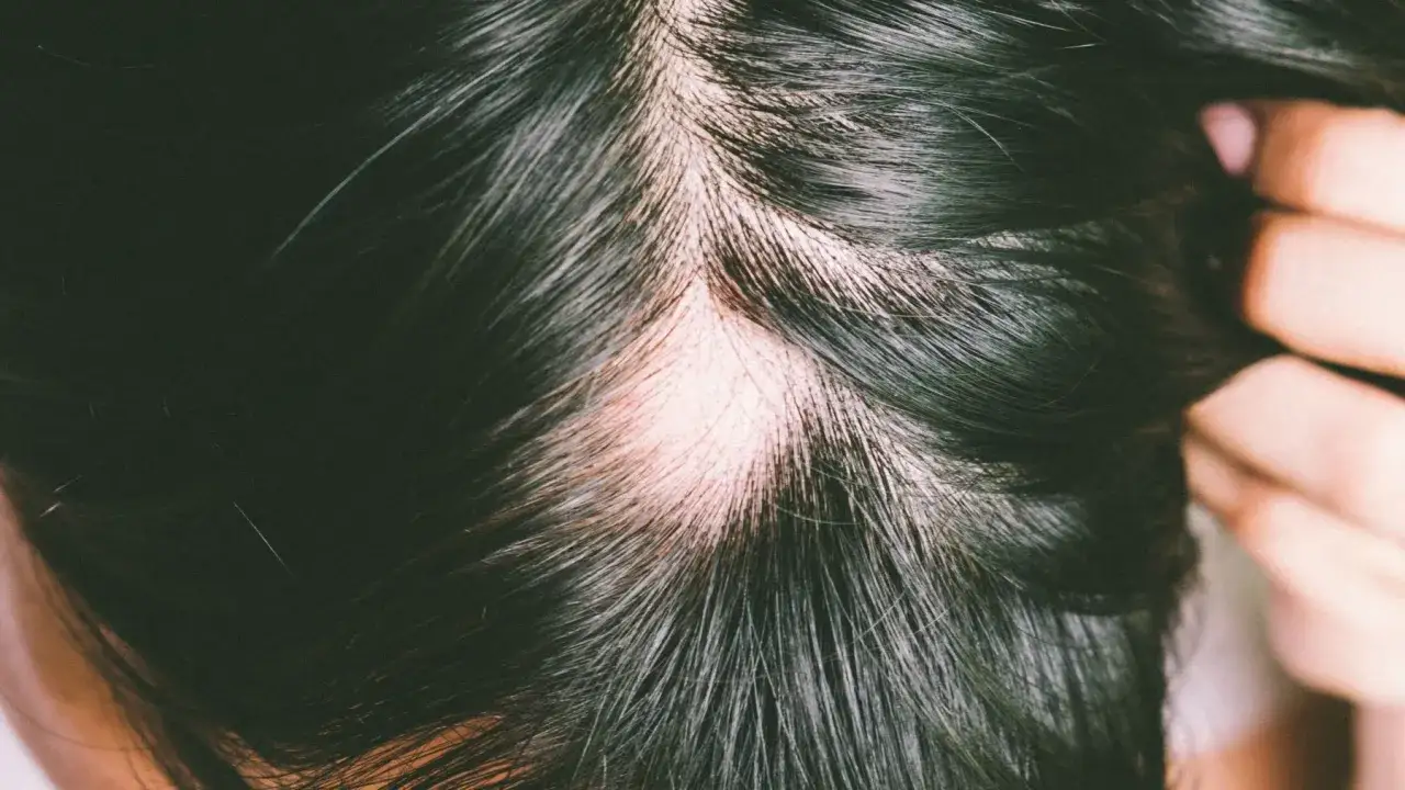 Widoczne łysienie plackowate, czyli alopecia. Skóra głowy z przerzedzonymi włosami.