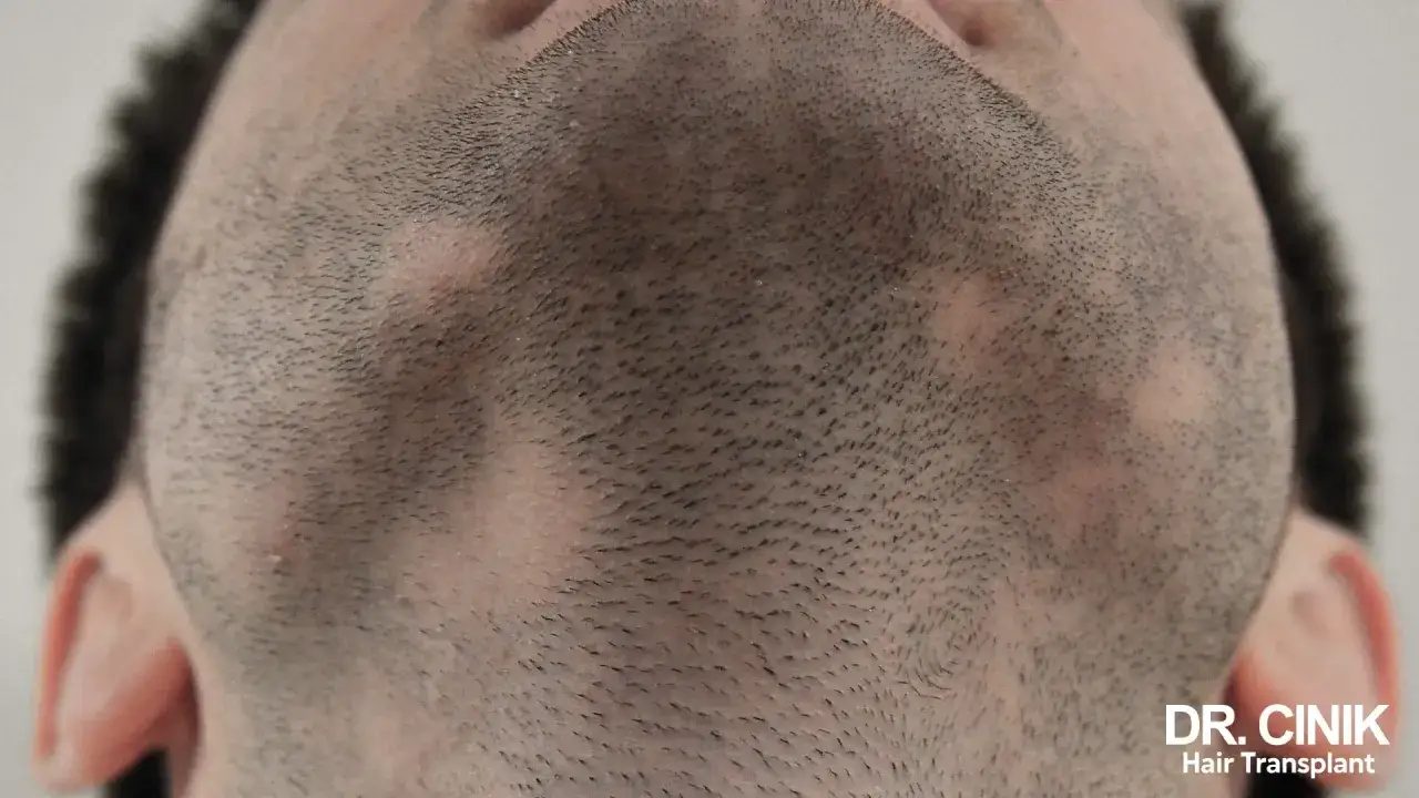 Gros plan sur un visage masculin montrant des zones de perte de barbe, des trous visibles. Le logo