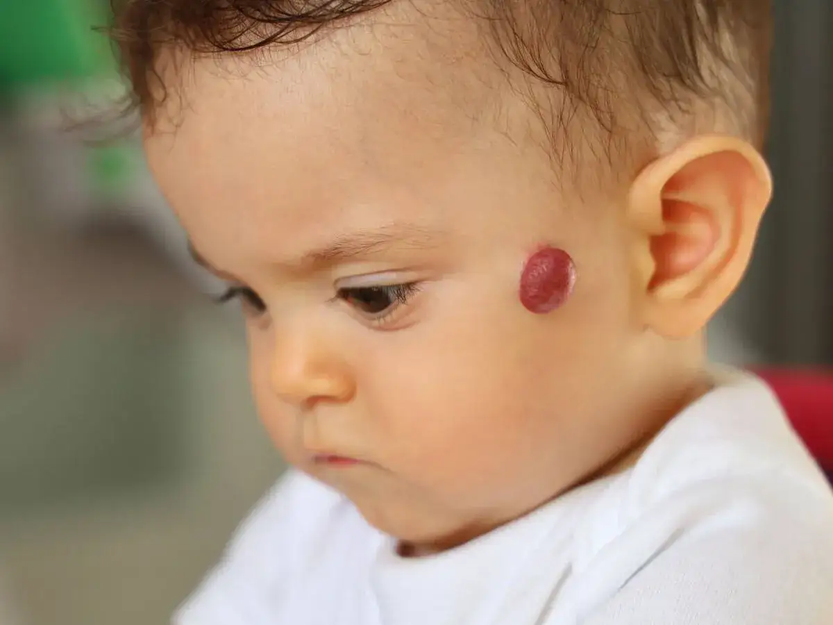 Primer plano de un beb&eacute; con un angioma rojo brillante en la mejilla.