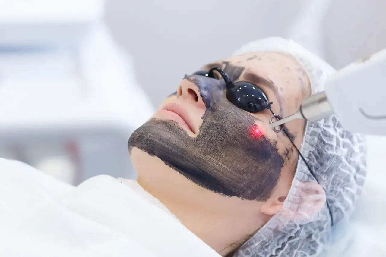 Peeling węglowy efekty przed i po